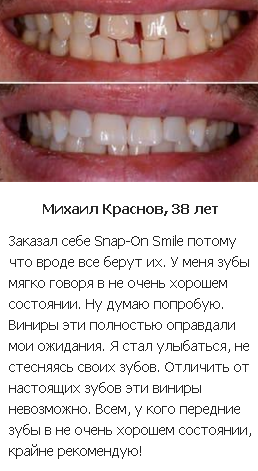 Snap On Smile отзывы покупателей