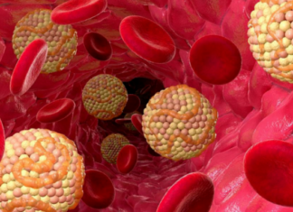 Чем опасны холестериновые бляшки?