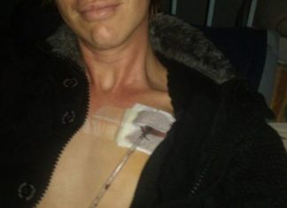 Что такое пневмоторакс?