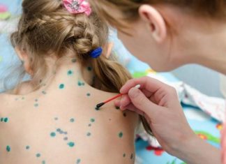 Как узнать, есть ли иммунитет к ветрянке?