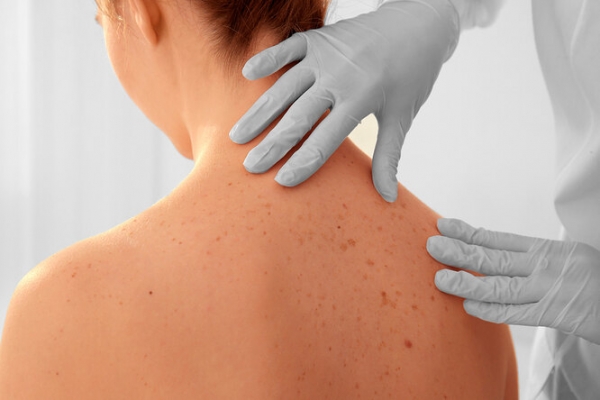 Рак кожи: 7 участков тела, которые мы не защищаем от УФ